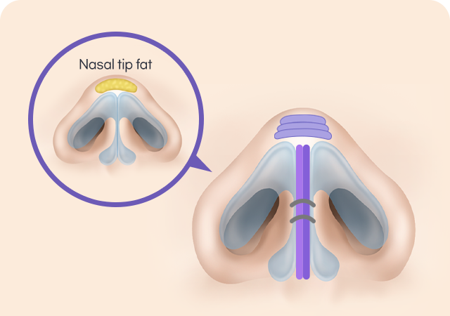 Nasal tip support