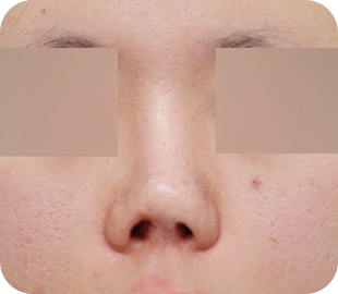 Revision rhinoplasty before case 6
