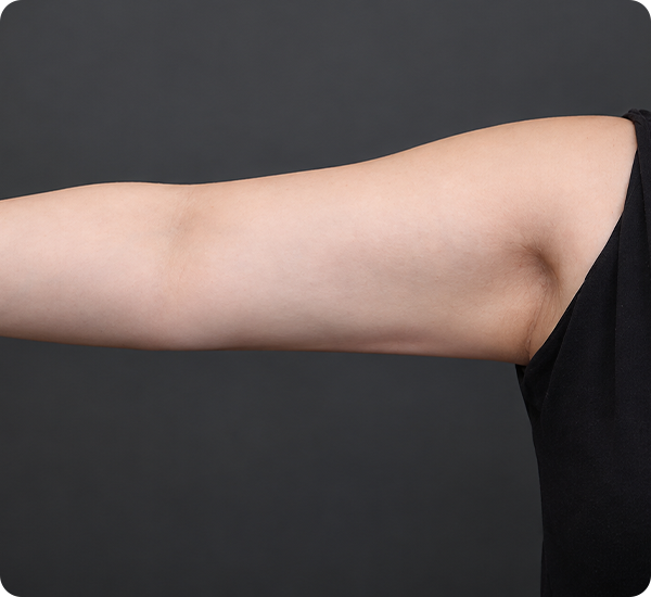 Arm lift case 01 six months after