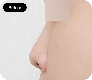 Low-bridge rhinoplasty before case 2