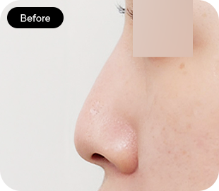 Low-bridge rhinoplasty before case 4