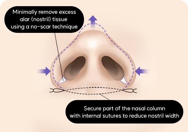 Alar base reduction