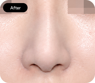 Bulbous nose rhinoplasty after case 5