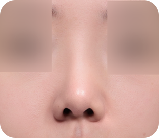 Revision rhinoplasty after case 2