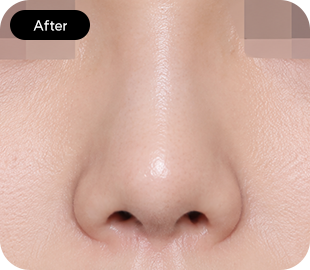 Bulbous nose rhinoplasty after case 2