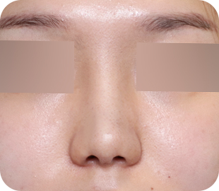 Revision rhinoplasty after case 7