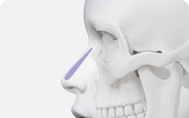 Nasal implant removal