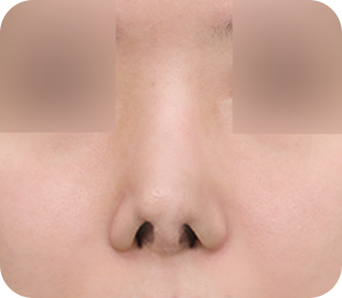 Revision rhinoplasty before case 4