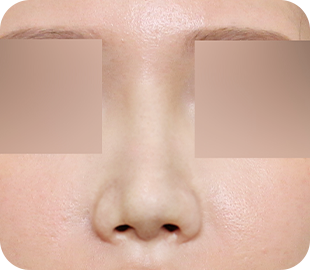 Revision rhinoplasty after case 5