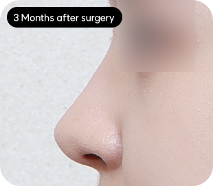 Low-bridge rhinoplasty after case 1
