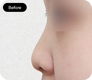 Low-bridge rhinoplasty before case 1