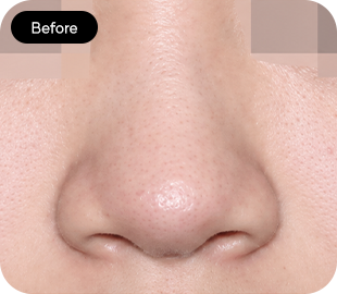 Bulbous nose rhinoplasty before case 1