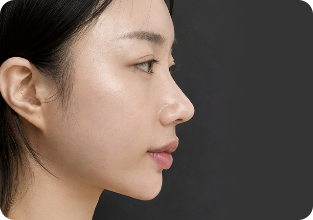 After rhinoplasty profile
