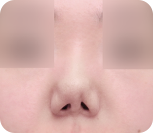 Revision rhinoplasty before case 2