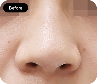 Bulbous nose rhinoplasty before case 3