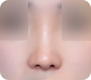 Revision rhinoplasty after case 3