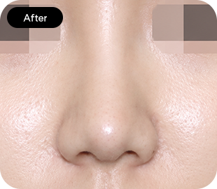 Bulbous nose rhinoplasty after case 4