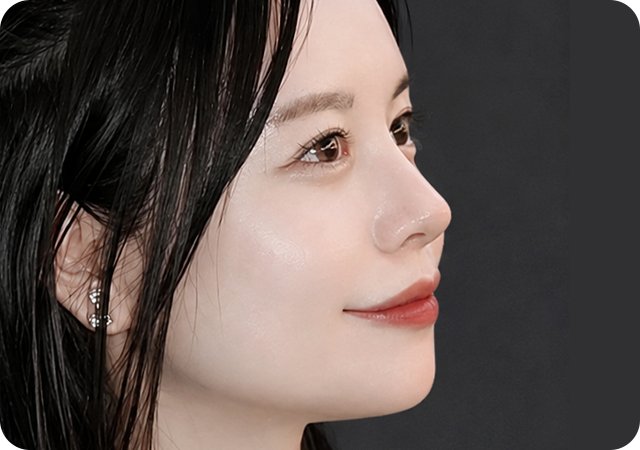 After rhinoplasty