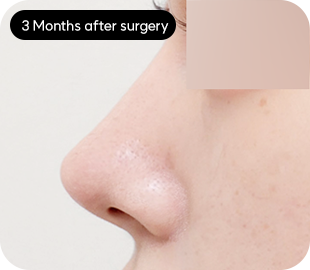 Low-bridge rhinoplasty after case 4