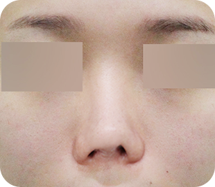Revision rhinoplasty before case 7
