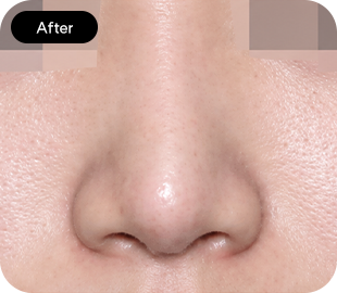 Bulbous nose rhinoplasty after case 1