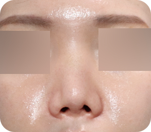 Revision rhinoplasty before case 5