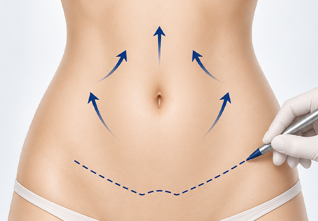 Full abdominoplasty bikini line incision