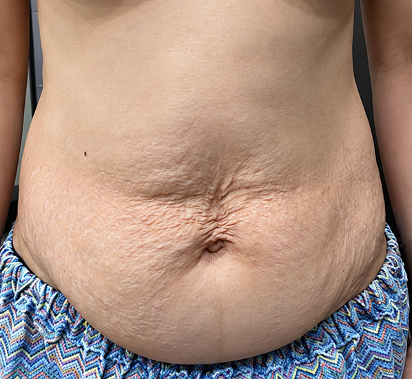 Abdominoplasty case 1 before surgery