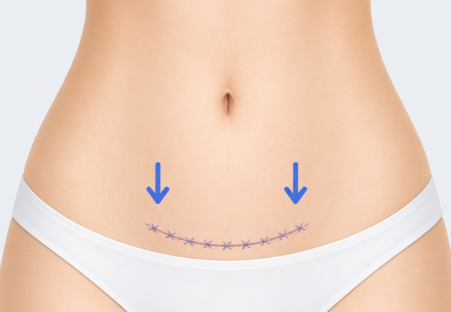 Mini abdominoplasty closure