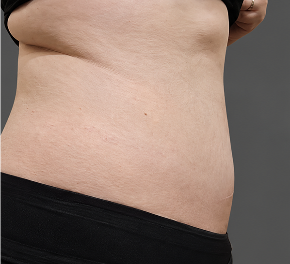 Abdominoplasty case 2 six months after surgery