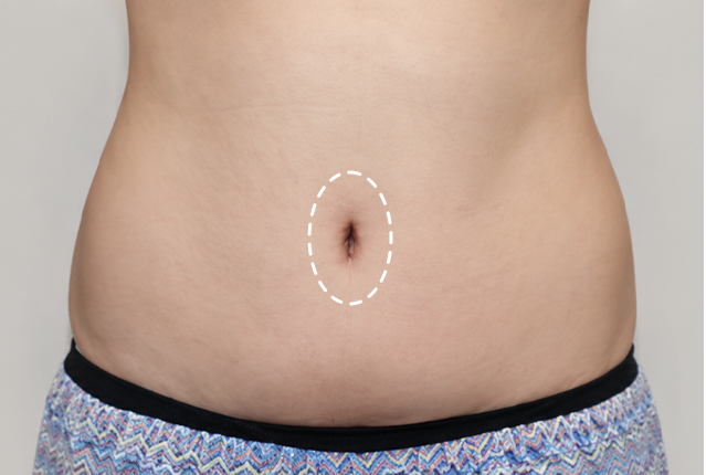 Navel six months after abdominoplasty