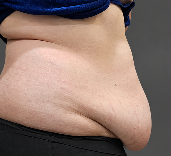 Abdominoplasty case 2 before surgery