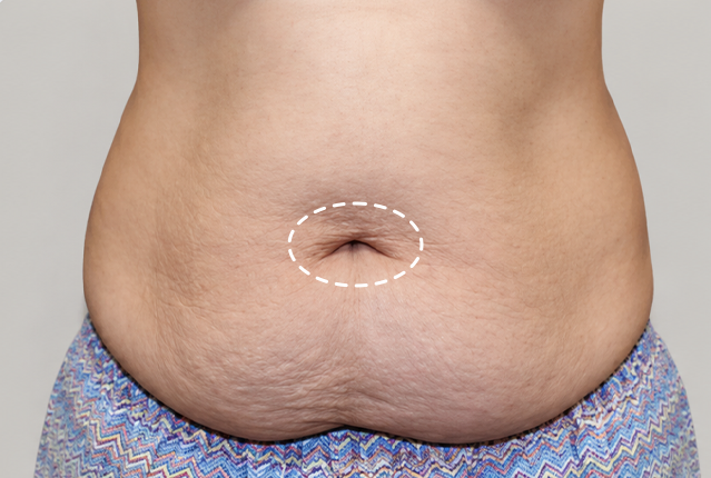 Navel before abdominoplasty