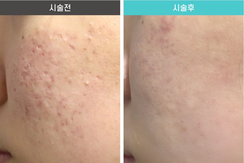 이즈의원 여드름 흉터 시술 전후사진 