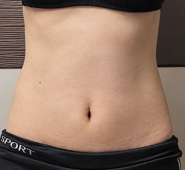 Abdominoplasty case 1 six months after surgery