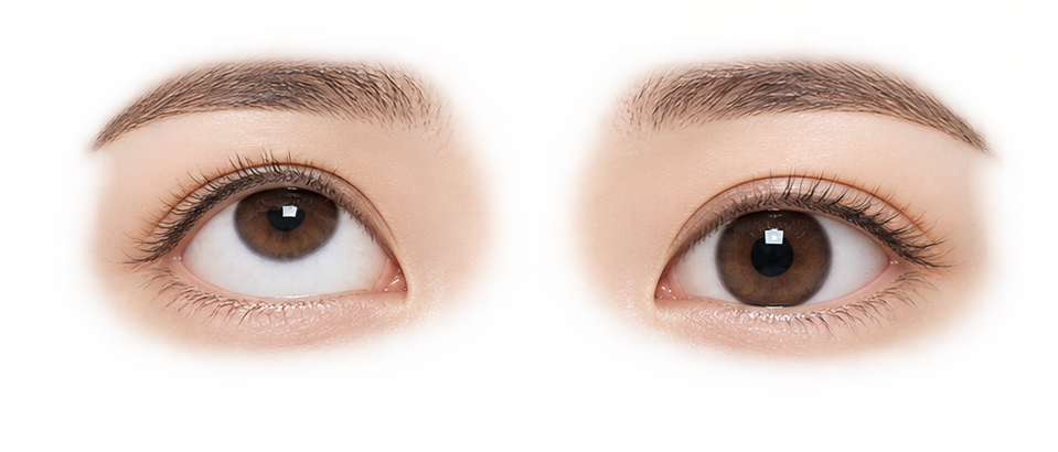 위아래로 치우쳐 보이는 수직사시 눈
