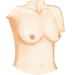 Implant breast augmentation
