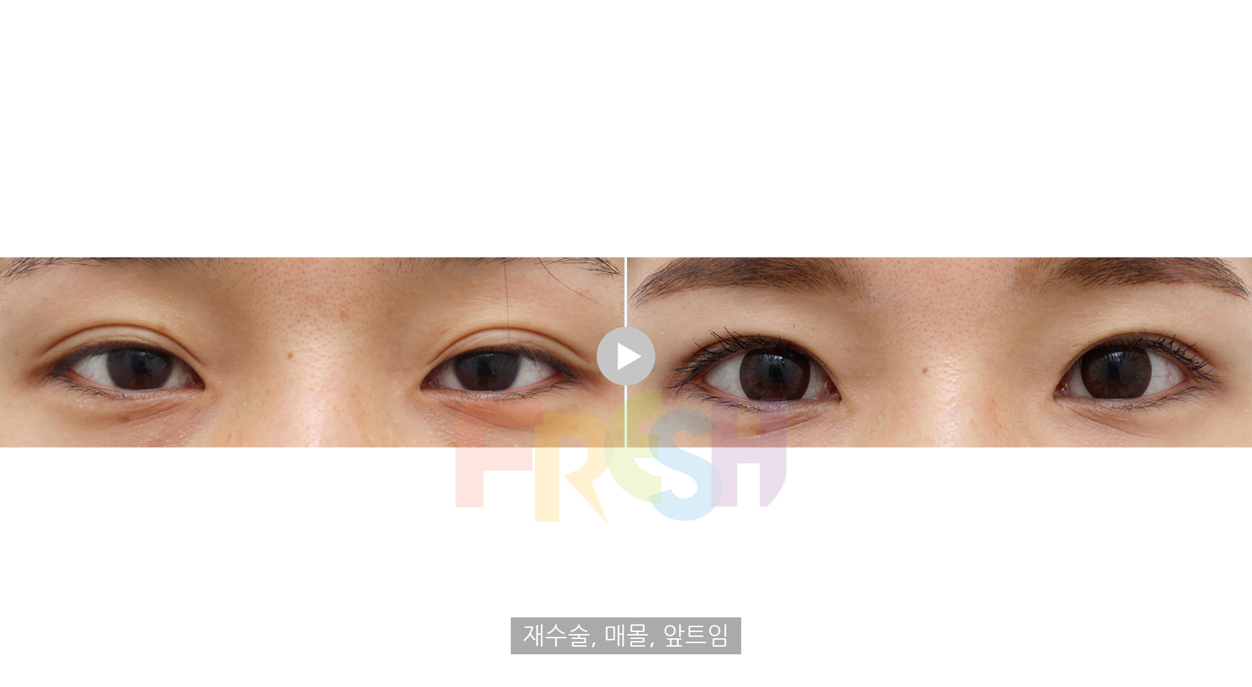 non incisional double eyelid