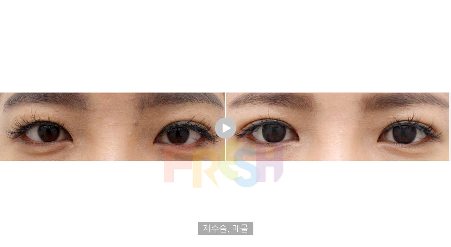 incisional eyelid surgery