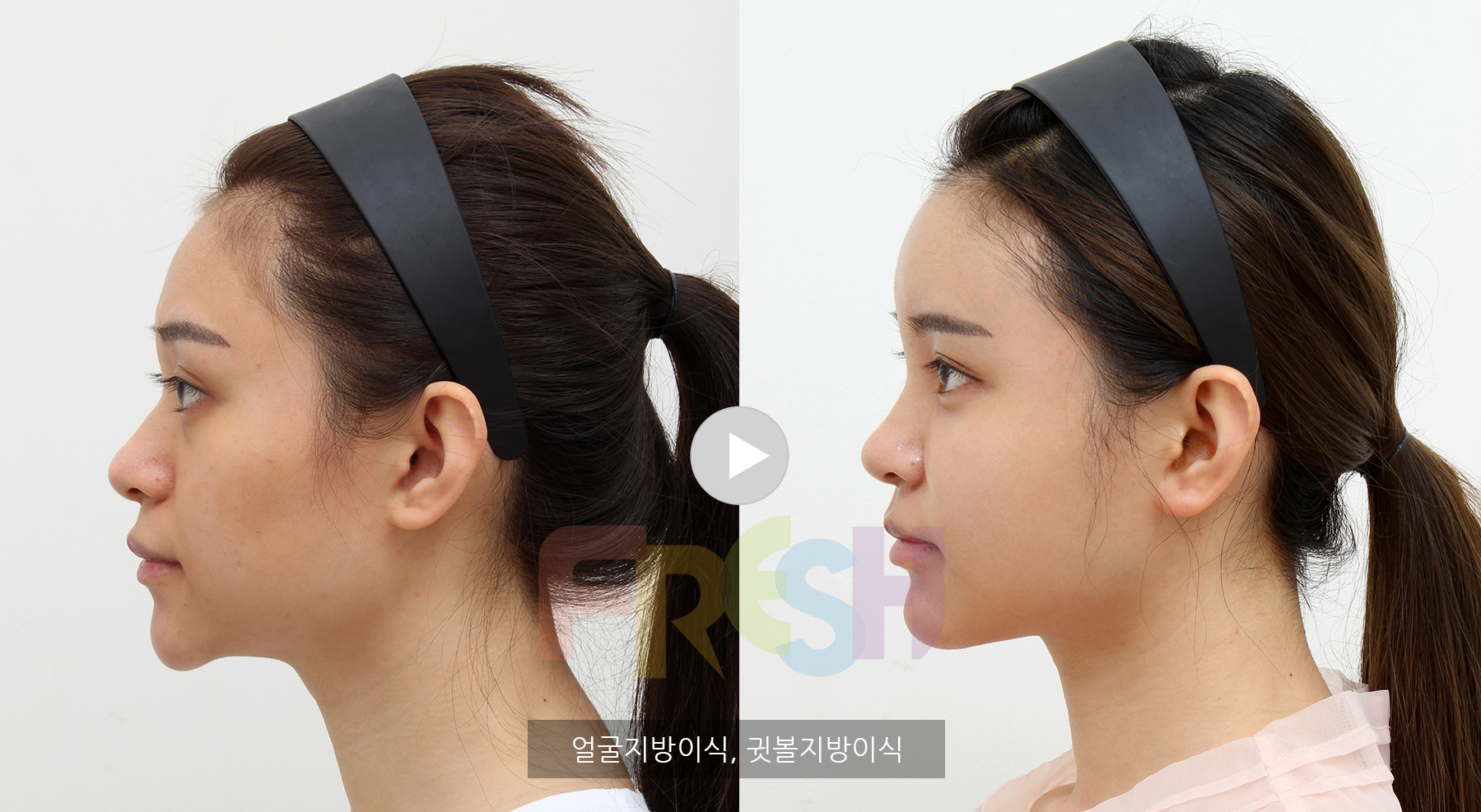 AccuZet V Contouring, Jaw Botox : Korean Plastic Surgery, Brazilian Butt  Lift