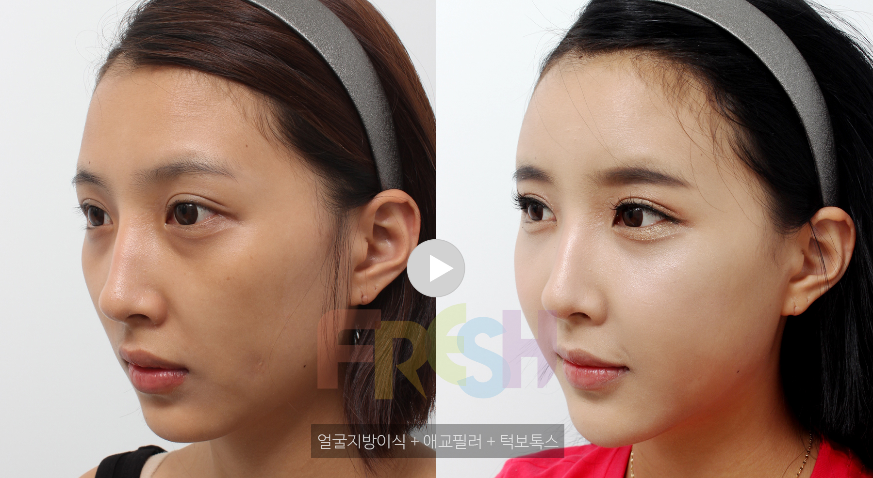 Facial Fat Grafting, Aegyo Filler, Jaw Botox : Korean Plastic Surgery ...