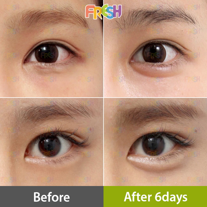 애교 필러 후기. 눈밑 지방이 두꺼운 동안 외모로