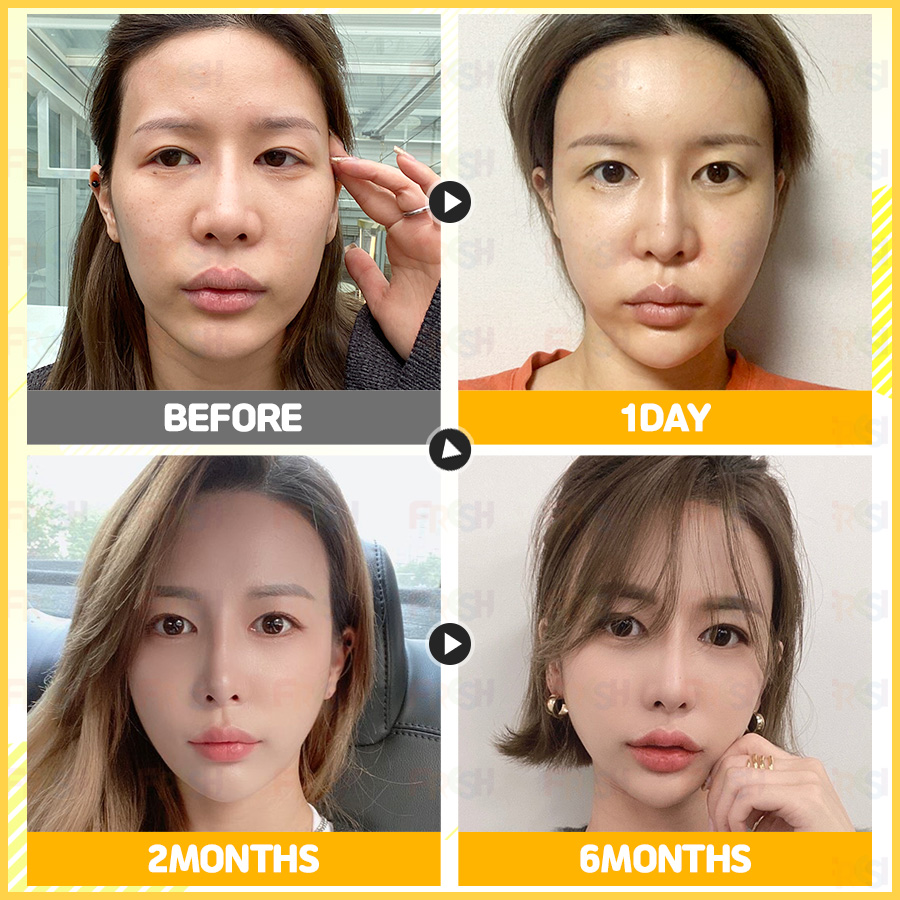 얼굴 지방이식 잘하는곳 쁘띠패드 인기있어 9