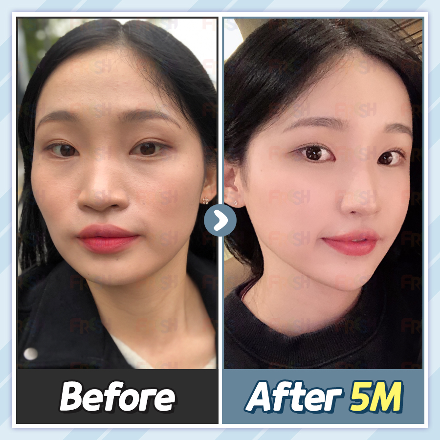 얼굴 지방이식 잘하는곳 쁘띠패드 인기있어 6