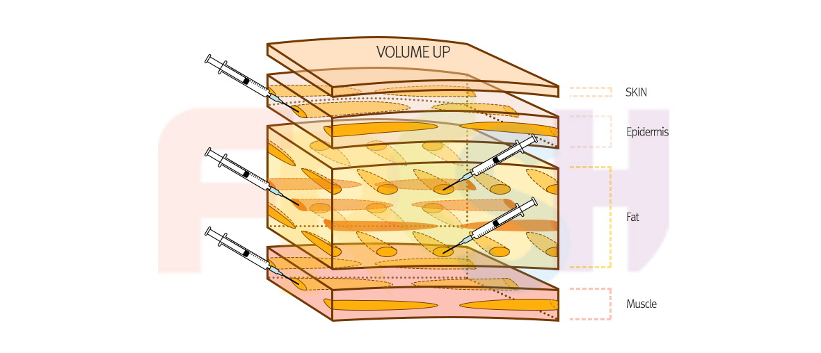 facial liposuction
