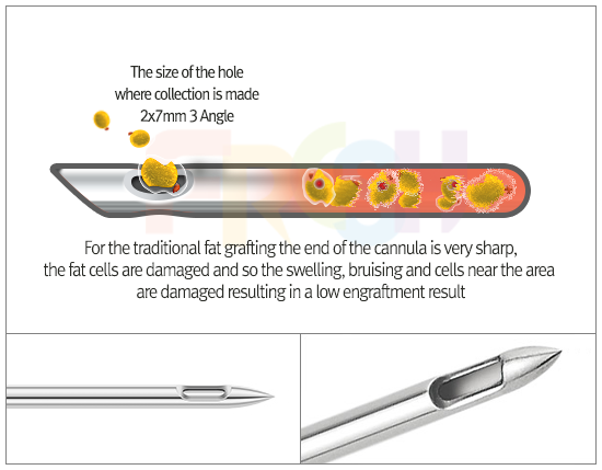facial liposuction