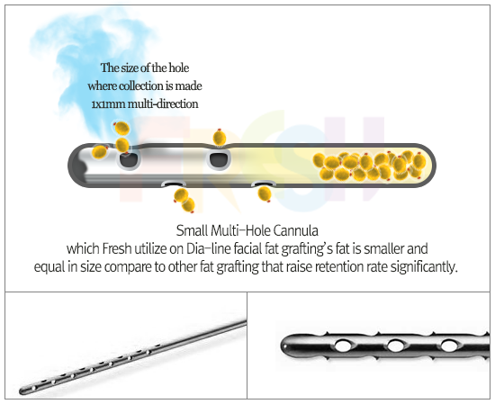 facial liposuction
