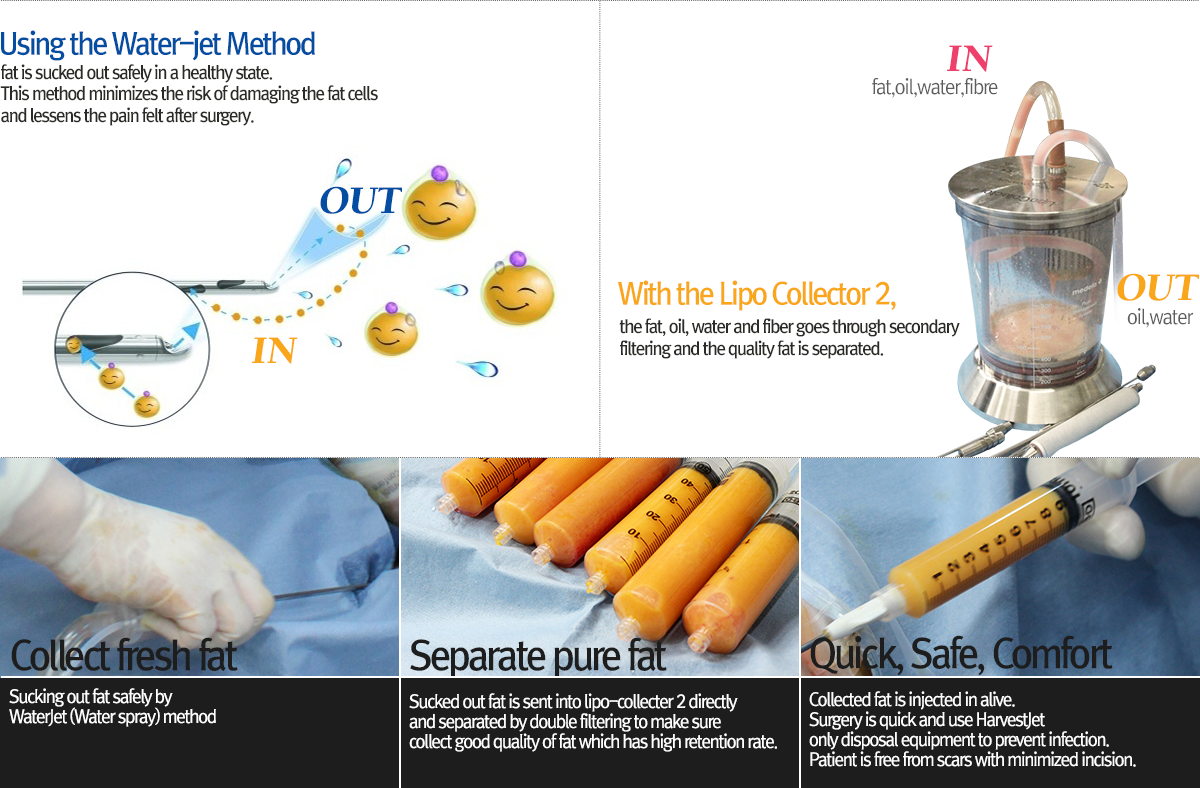 facial liposuction
