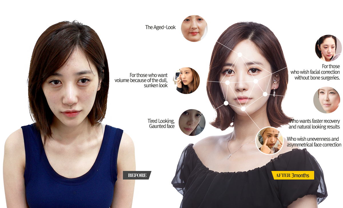 facial liposuction