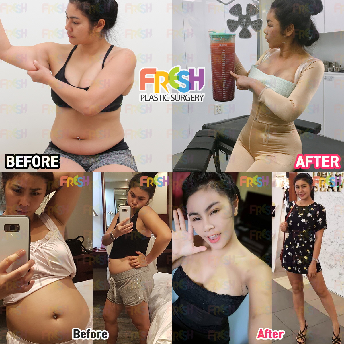 Full body Liposuction : Reviews with photos